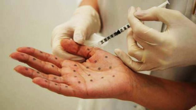 injection-botox-transpiration-dr-loreto-chirurgien-esthetique-paris