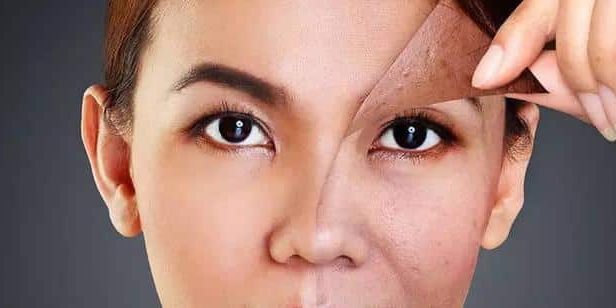 Peeling doux et microneedling